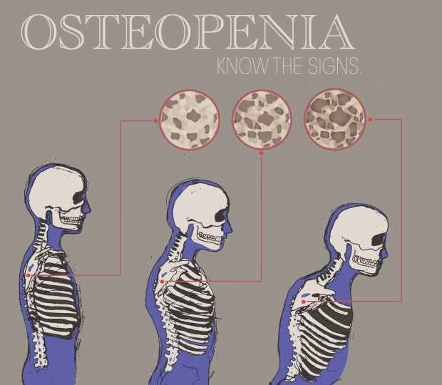 Osteopenia_png